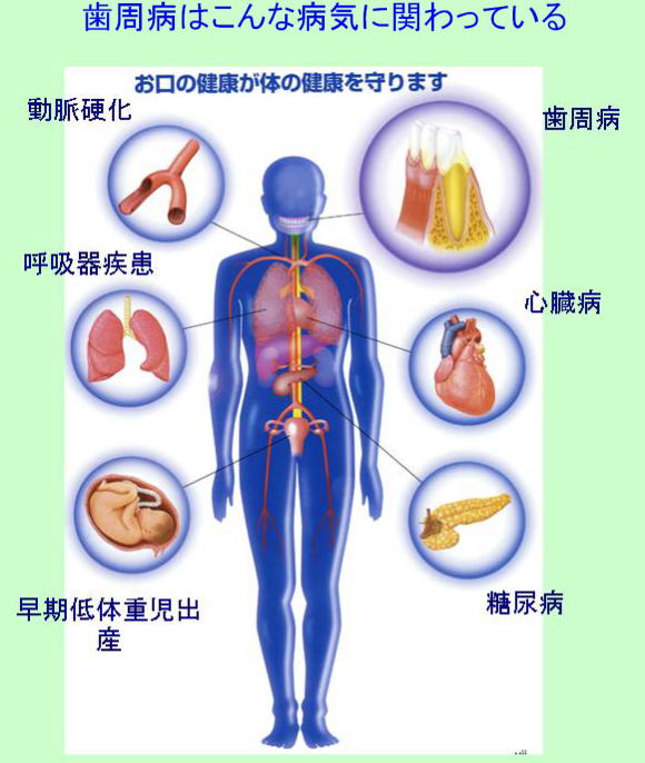 歯周病が関わる疾患　動脈硬化・呼吸器疾患・歯周病・心臓病・糖尿病・早期低体重児出産